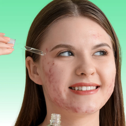 Blemish Blitz Superfood Face Oil