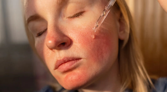 7 Signs Your Sensitive Skin May Be Experiencing Skin Burnout